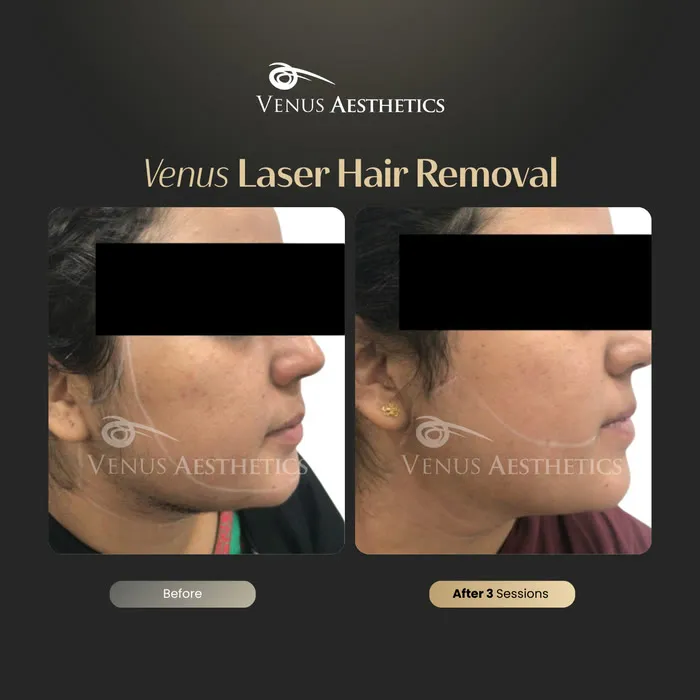 Laser hair removal before and after result at Luxeria Clinic