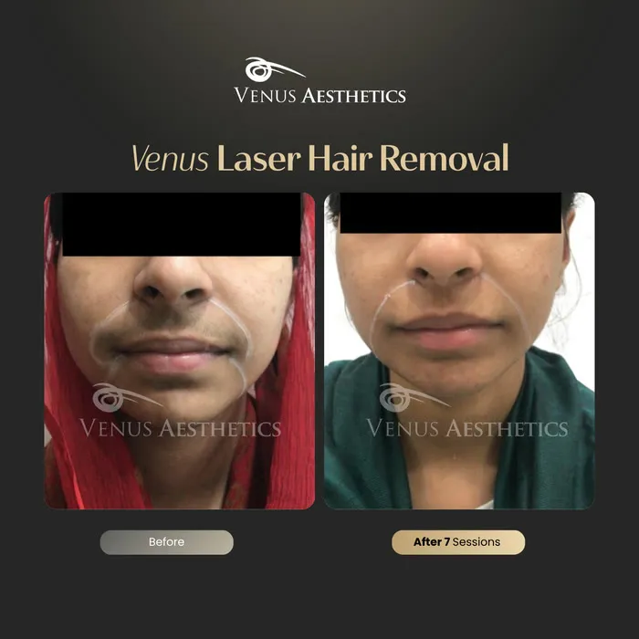 Laser hair removal before and after photo of an actual Luxeria Clinic client, 4 of 17
