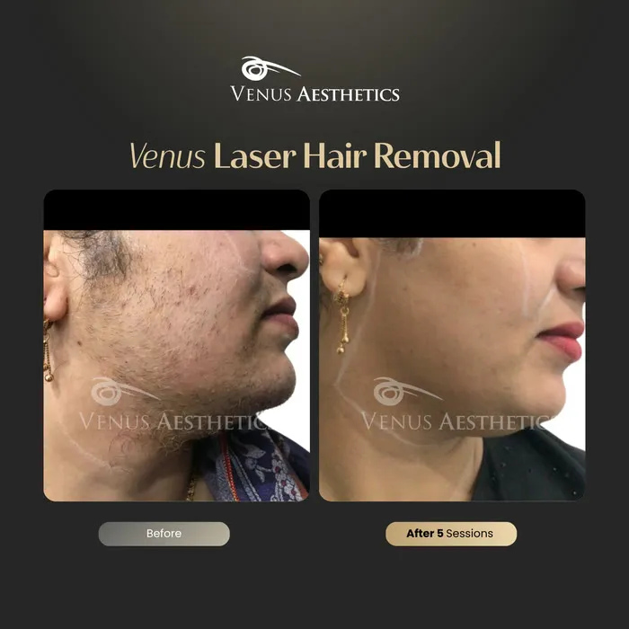 Laser hair removal before and after photo of an actual Luxeria Clinic client, 5 of 17