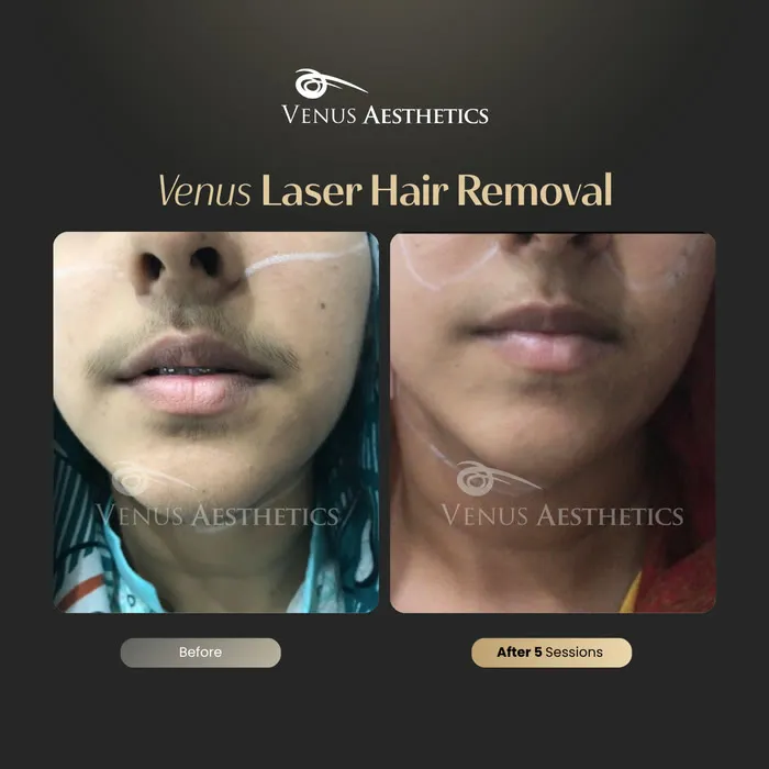Laser hair removal before and after result at Luxeria Clinic