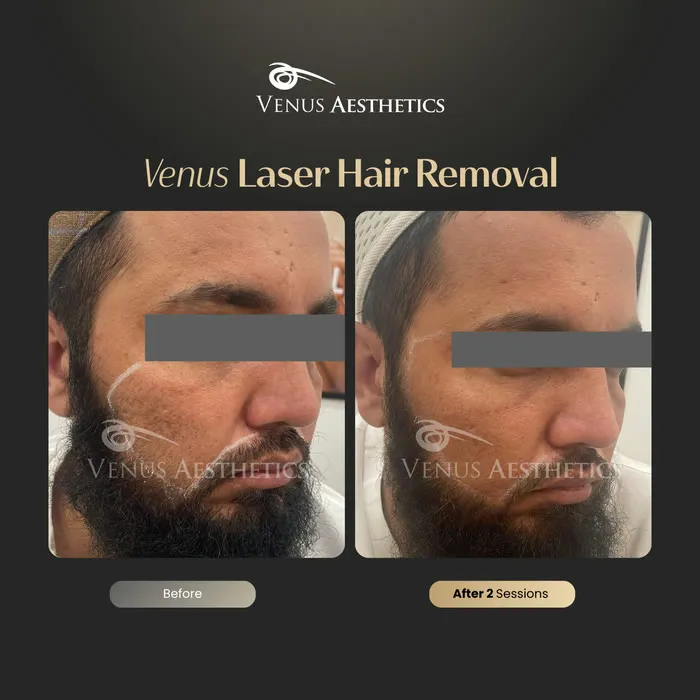 Laser hair removal before and after photo of an actual Luxeria Clinic client, 7 of 17