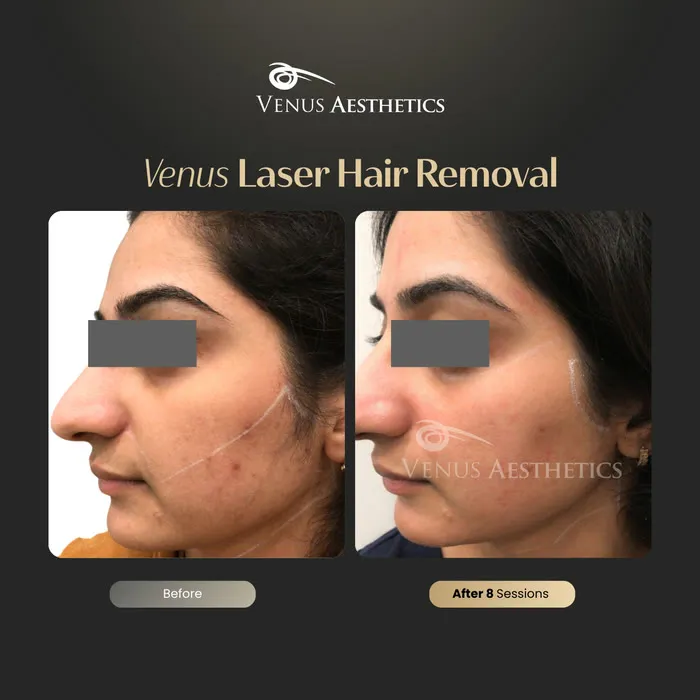 Laser hair removal before and after photo of an actual Luxeria Clinic client, 8 of 17