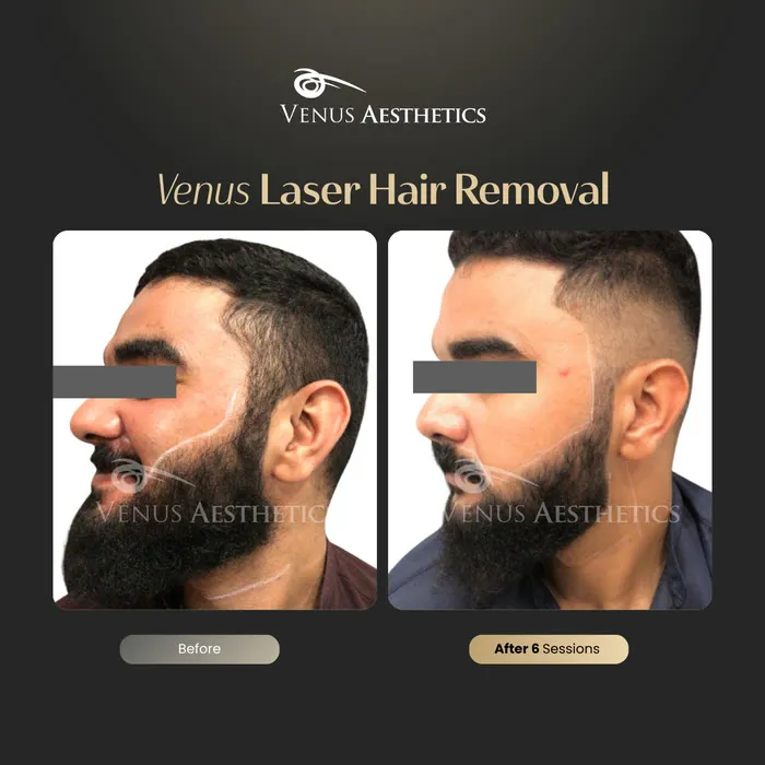 Laser hair removal before and after result at Luxeria Clinic