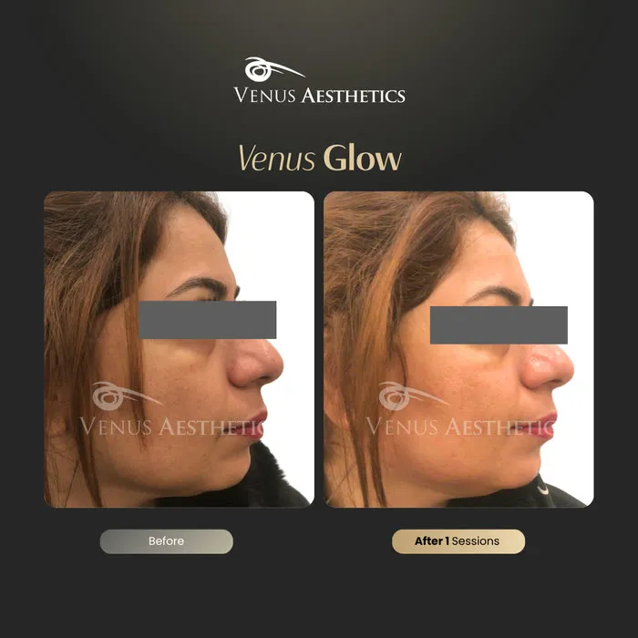 luxeria Glow facial before and after result at Luxeria Clinic