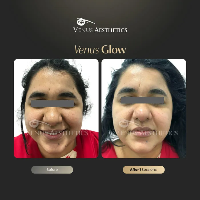 luxeria Glow facial before and after result at Luxeria Clinic