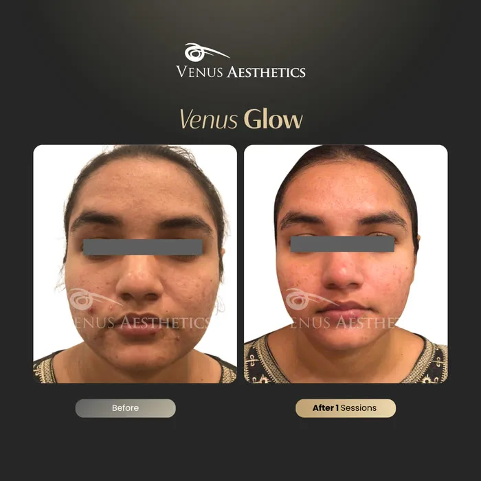 luxeria Glow facial before and after result at Luxeria Clinic