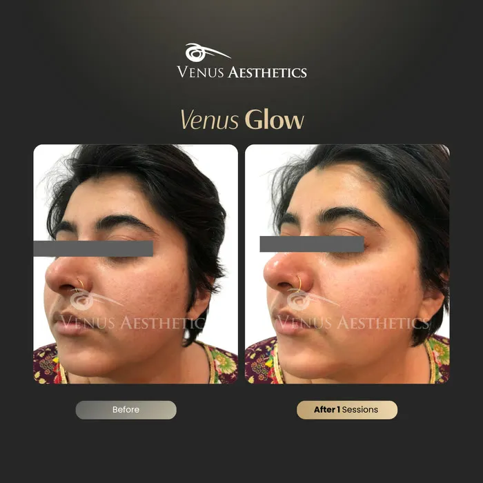 luxeria Glow facial before and after result at Luxeria Clinic