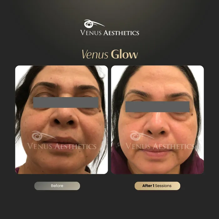 luxeria Glow facial before and after result at Luxeria Clinic