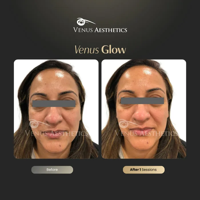 luxeria Glow facial before and after result at Luxeria Clinic