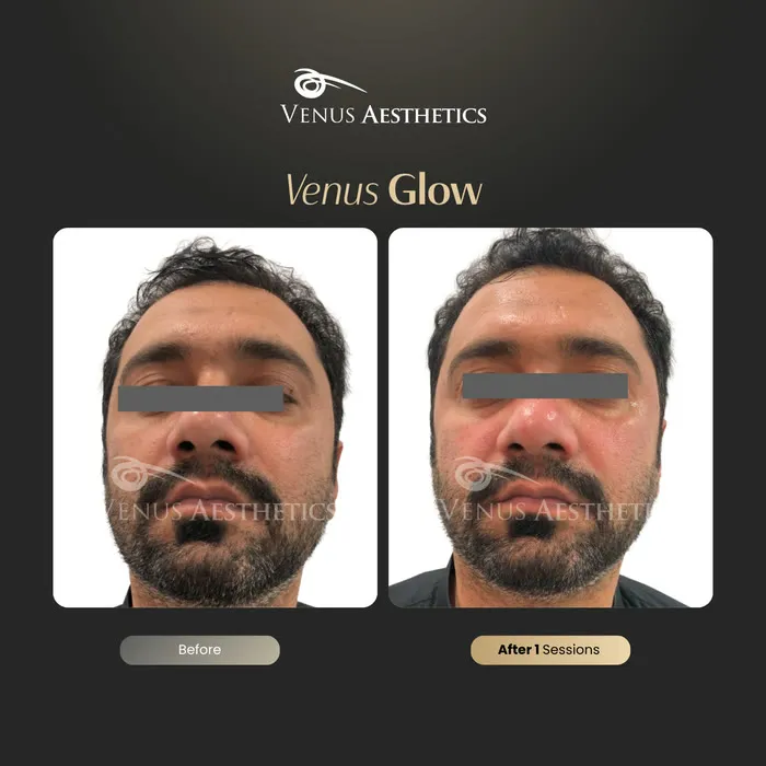 luxeria Glow facial before and after result at Luxeria Clinic