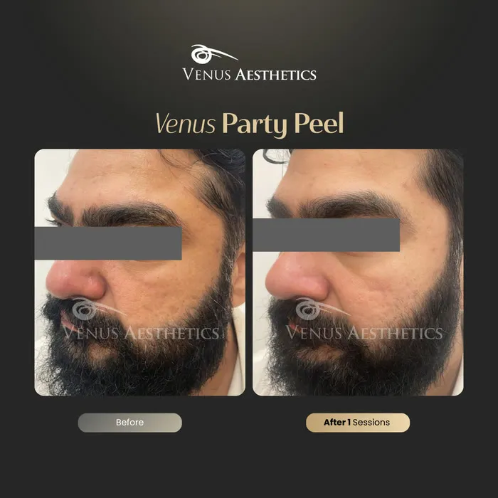 Party Peel brightening peel before and after photo of an actual Luxeria Clinic client, 1 of 6