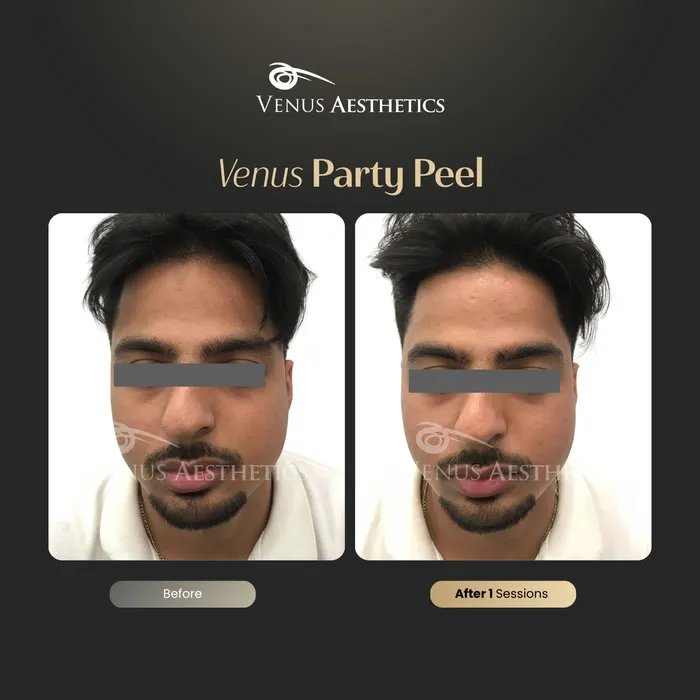 Party peel before and after result at Luxeria Clinic