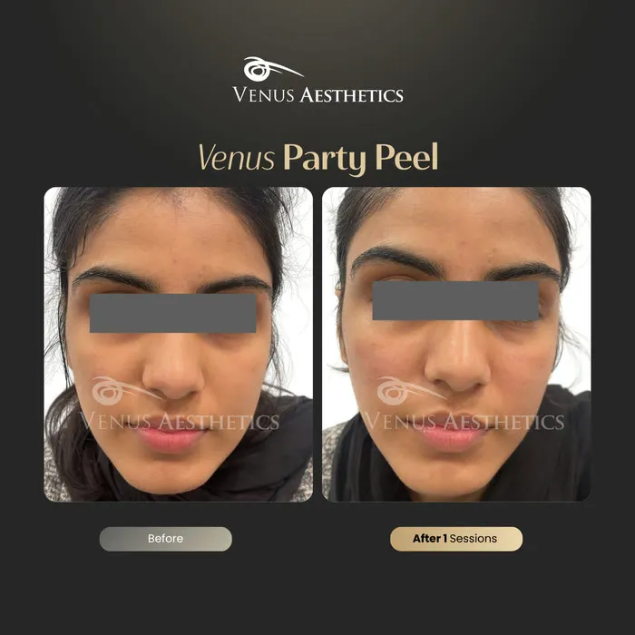 Party peel before and after result at Luxeria Clinic