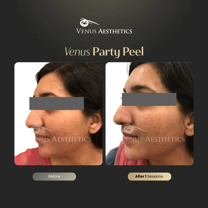 Party peel before and after result at Luxeria Clinic
