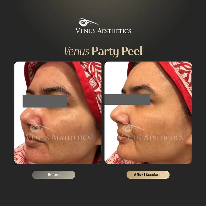 Party peel before and after result at Luxeria Clinic