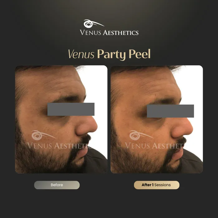 Party Peel brightening peel before and after photo of an actual Luxeria Clinic client, 6 of 6