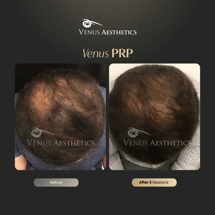 Fusion PRP hair before and after result at Luxeria Clinic