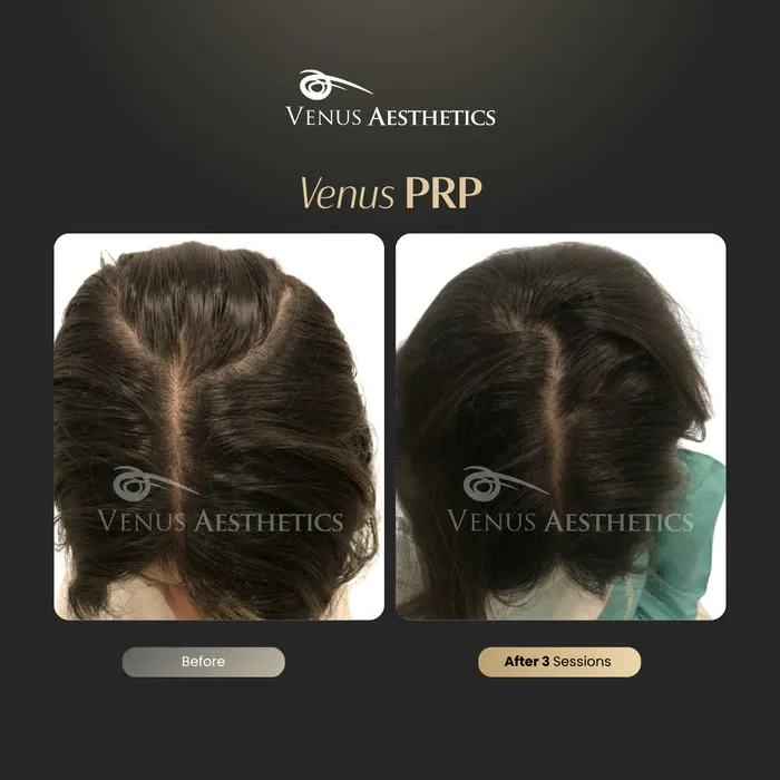 PRP hair restoration before and after result at Luxeria Clinic