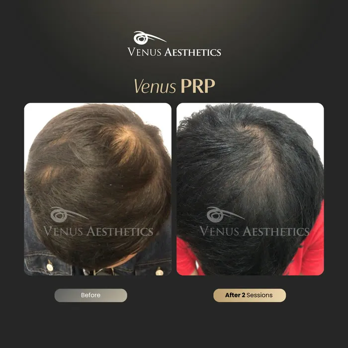 PRP hair restoration before and after result at Luxeria Clinic