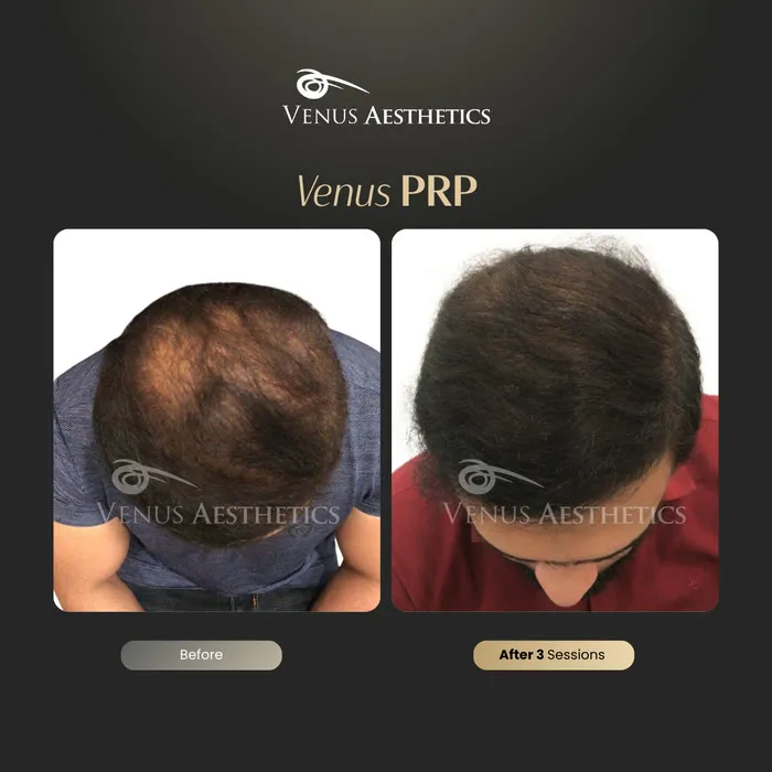 PRP hair restoration before and after result at Luxeria Clinic