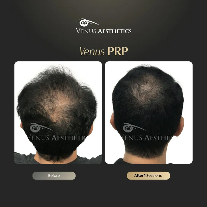 PRP hair restoration before and after result at Luxeria Clinic