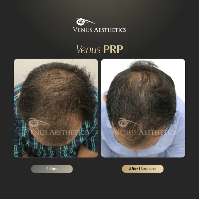 PRP hair restoration before and after result at Luxeria Clinic