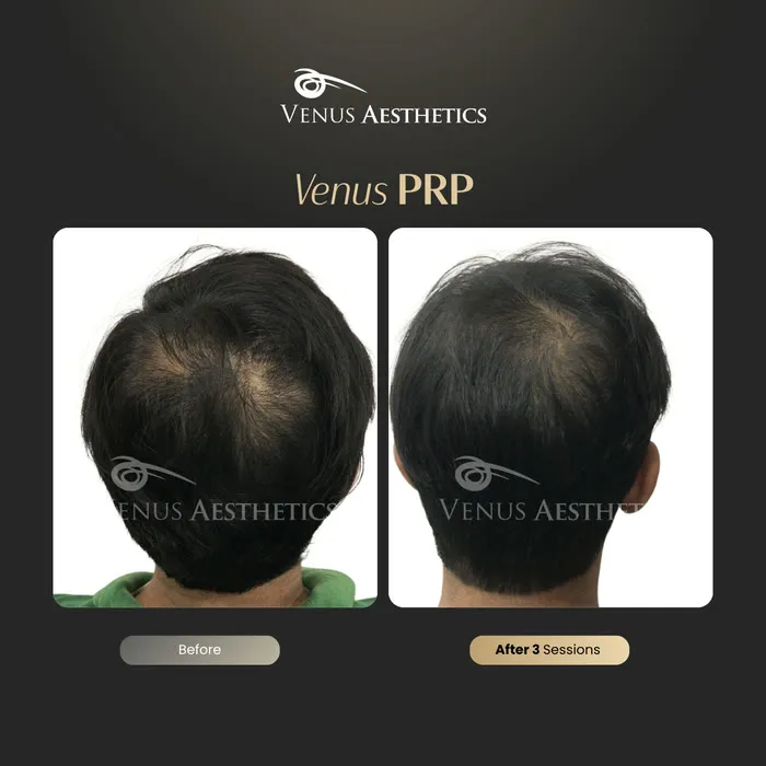 PRP hair restoration before and after result at Luxeria Clinic