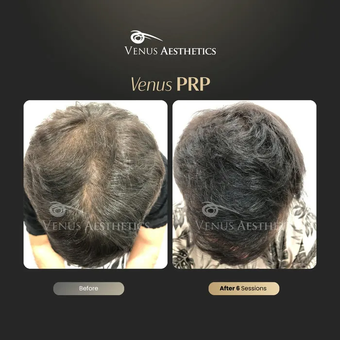 PRP hair restoration before and after result at Luxeria Clinic