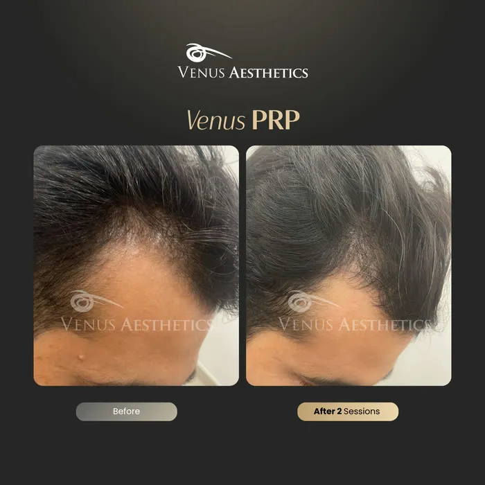 Fusion PRP hair before and after result at Luxeria Clinic