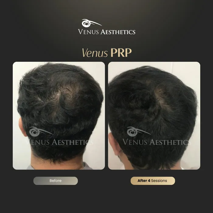 Fusion PRP hair before and after result at Luxeria Clinic