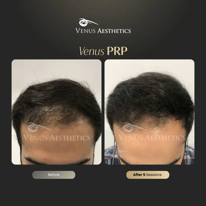 luxeria PRP hair treatment before and after photo of an actual Luxeria Clinic client, 4 of 16