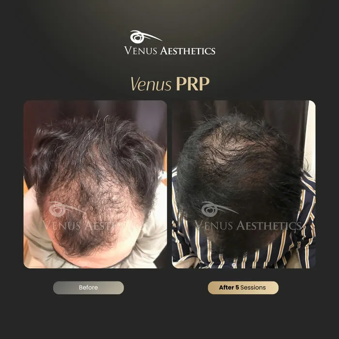 Fusion PRP hair before and after result at Luxeria Clinic