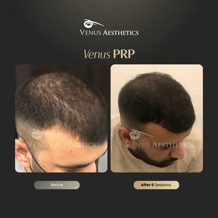 Fusion PRP hair before and after result at Luxeria Clinic