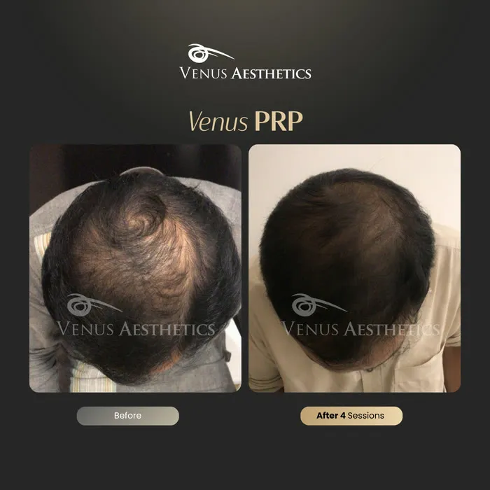Fusion PRP hair before and after result at Luxeria Clinic