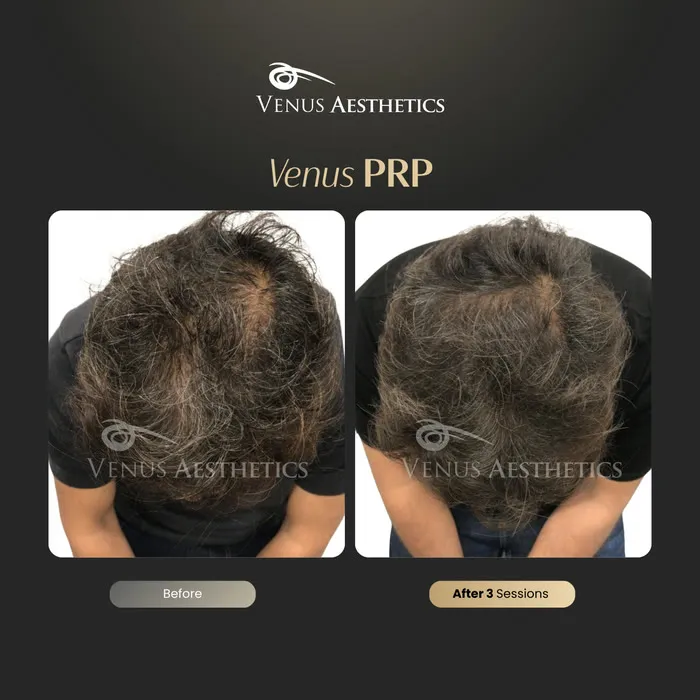 PRP hair restoration before and after result at Luxeria Clinic