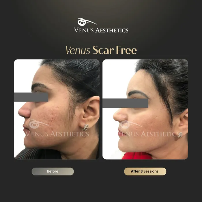 Scar removal before and after result at Luxeria Clinic