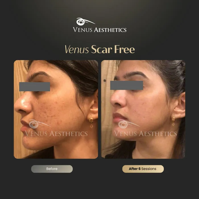 luxeria Scar Free scar treatment before and after photo of an actual Luxeria Clinic client, 10 of 13