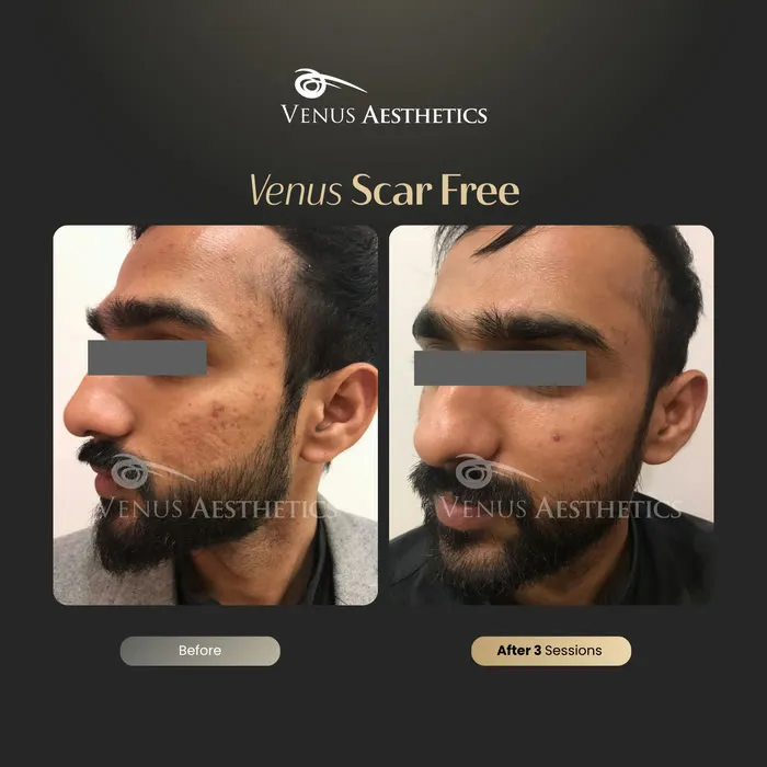 Scar removal before and after result at Luxeria Clinic
