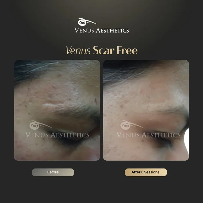 luxeria Scar Free scar treatment before and after photo of an actual Luxeria Clinic client, 12 of 13