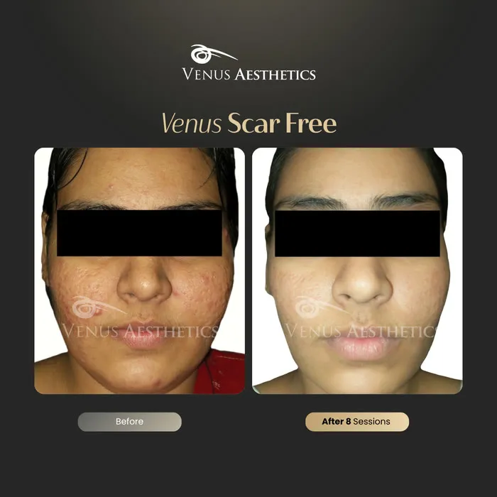 Scar removal before and after result at Luxeria Clinic