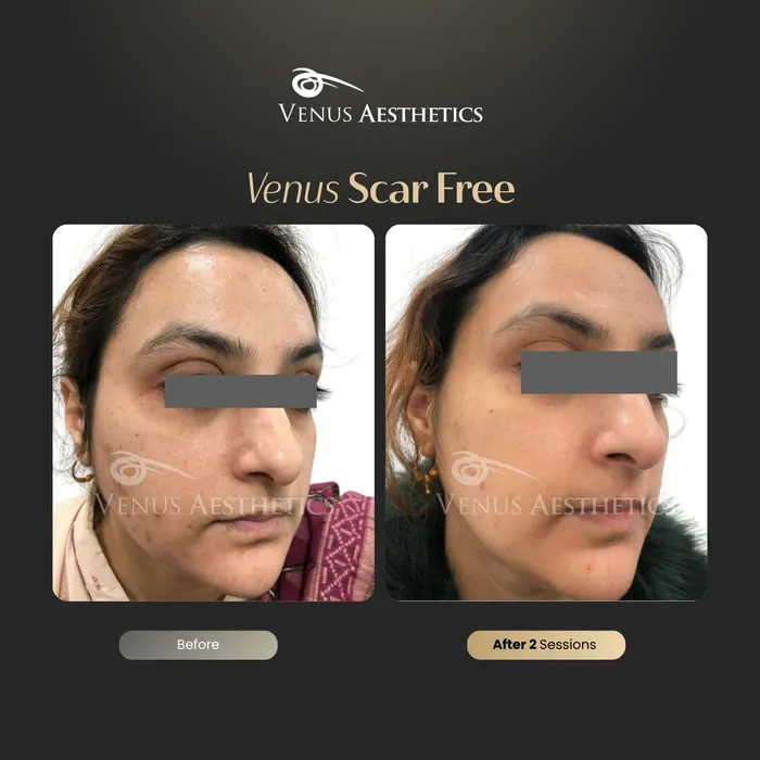 Scar removal before and after result at Luxeria Clinic
