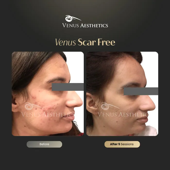 Scar removal before and after result at Luxeria Clinic