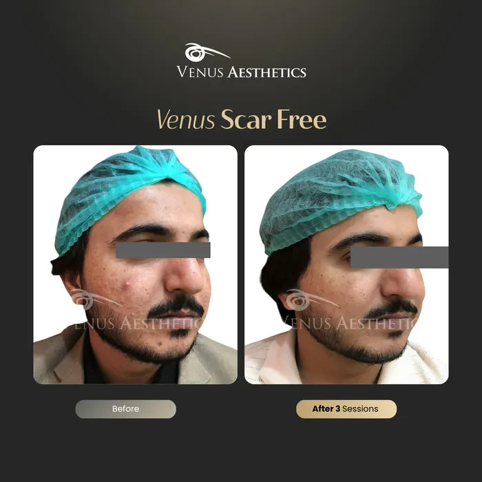 Scar removal before and after result at Luxeria Clinic