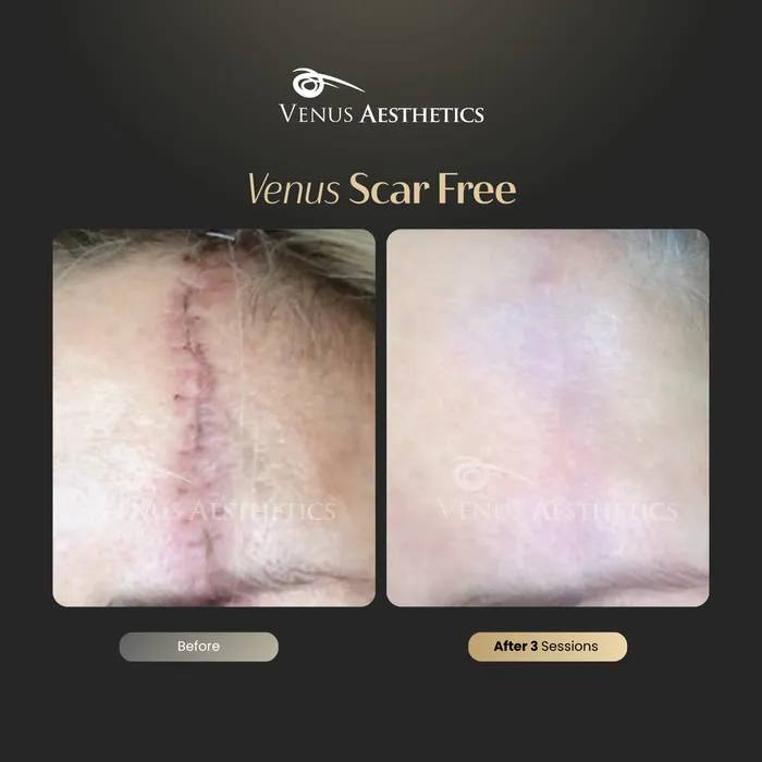Scar removal before and after result at Luxeria Clinic