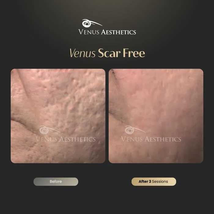 Scar removal before and after result at Luxeria Clinic