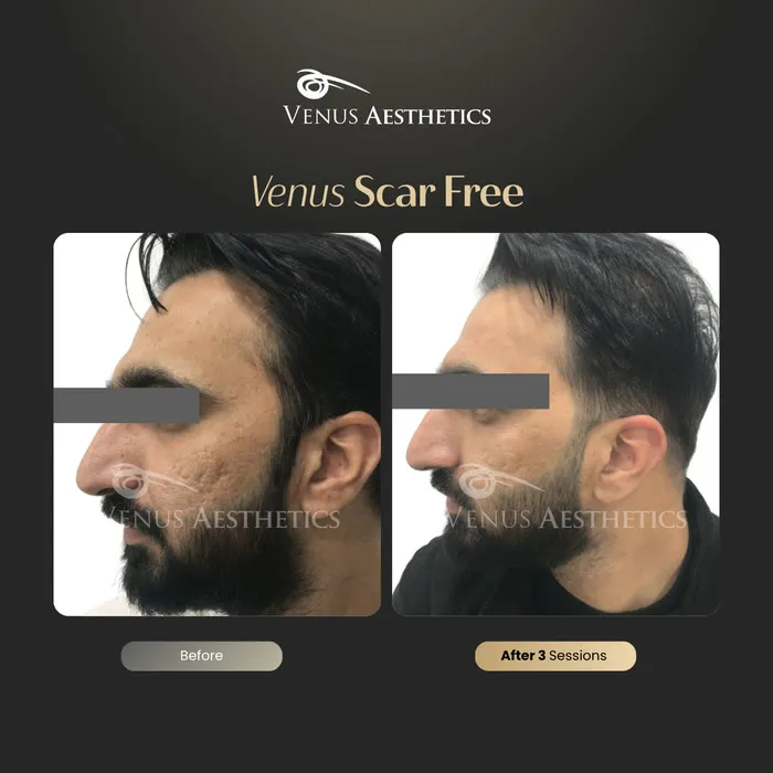 Scar removal before and after result at Luxeria Clinic