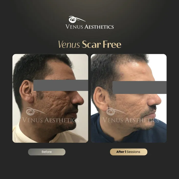 Scar removal before and after result at Luxeria Clinic