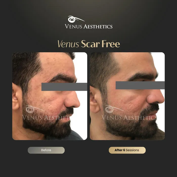 Scar removal before and after result at Luxeria Clinic