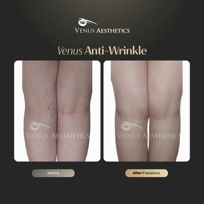 Stretch mark removal before and after result at Luxeria Clinic
