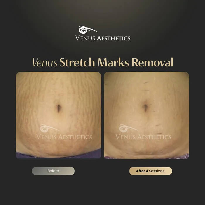 luxeria Stretch Mark Treatment before and after photo of an actual Luxeria Clinic client, 2 of 2